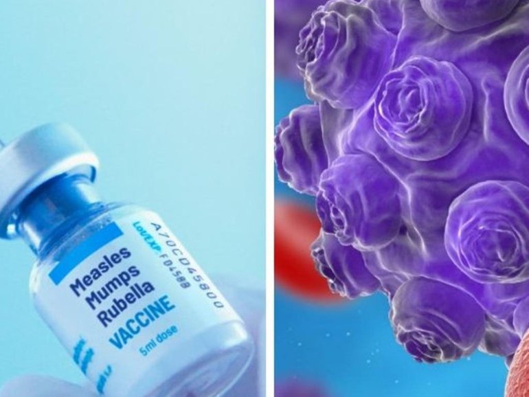A confirmed measles case has been detected in the Sutherland Shire. Image: Supplied
