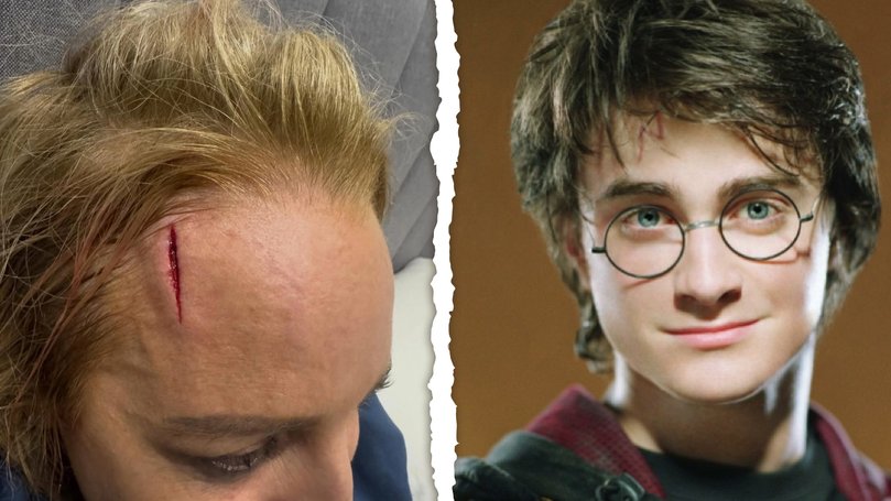Carrie Bickmore has been compared to Harry Potter following her nasty facial injury.