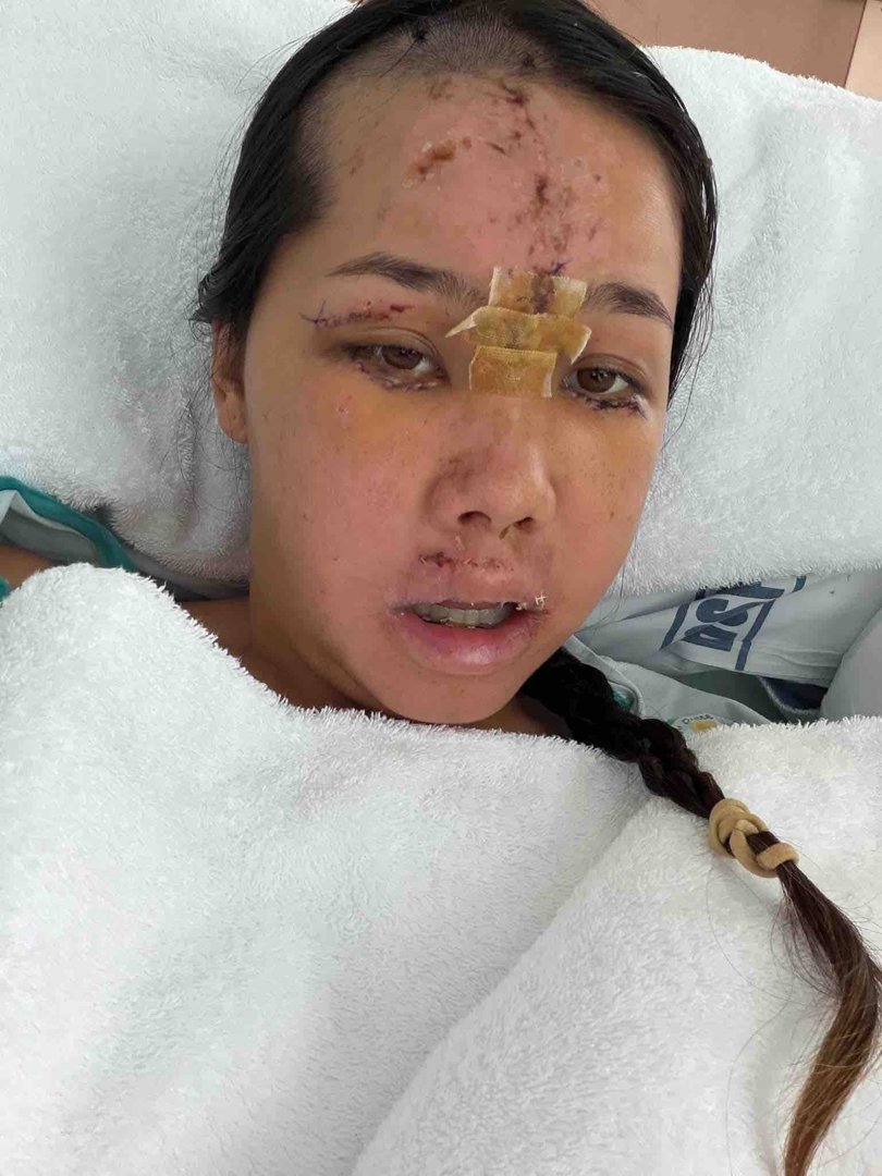 Ms Escabarte underwent several surgeries in hospital.