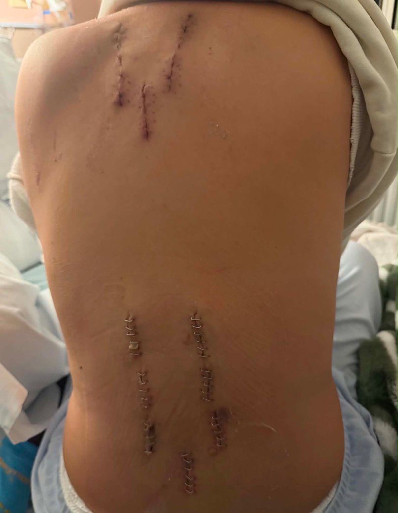 Ms Escabarte's back was injured in the accident.