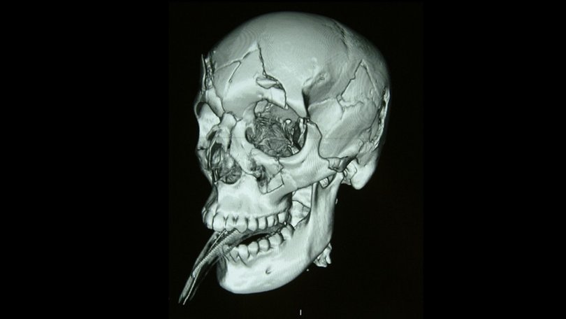 An X-ray of Lauren Huxley's skull after being attacked by Robert Black Farmer. Picture: Supplied.
