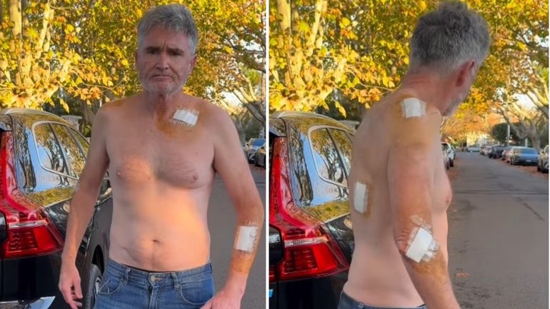 Comedian Dave Hughes had 45 stitches after five cancerous lesions were cut out.  