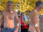 Comedian Dave Hughes had 45 stitches after five cancerous lesions were cut out.  