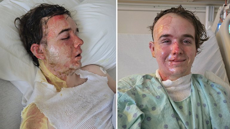 McDonald's worker fights for life after hot oil was thrown on him.