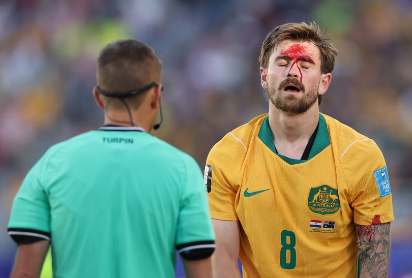 Connor Metcalfe after getting kicked in the head.