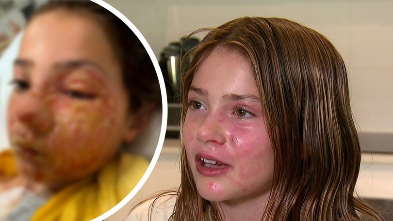 A Queensland family has become the target of a vicious torrent of online abuse after Violet Zerbst suffered severe facial burns when a squishy sensory toy exploded.