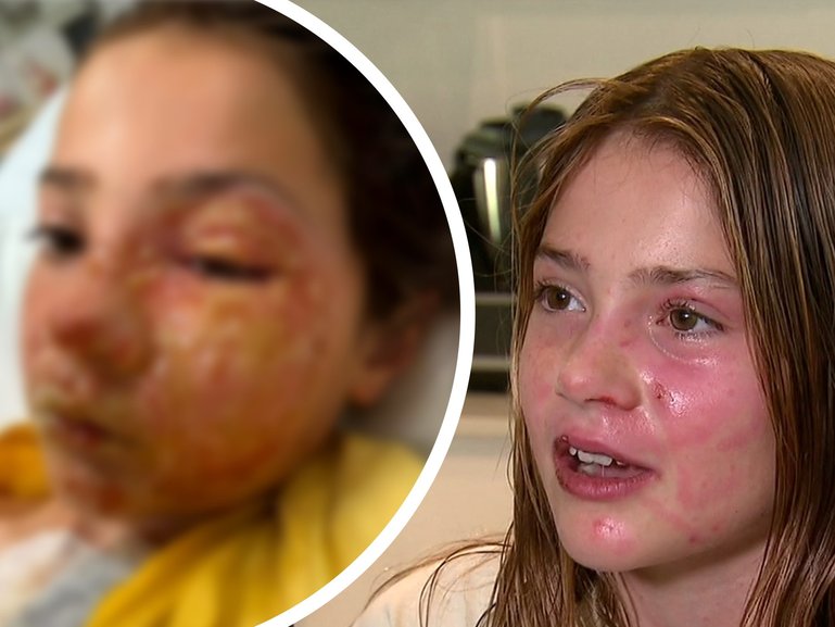 A Queensland family has become the target of a vicious torrent of online abuse after Violet Zerbst suffered severe facial burns when a squishy sensory toy exploded.