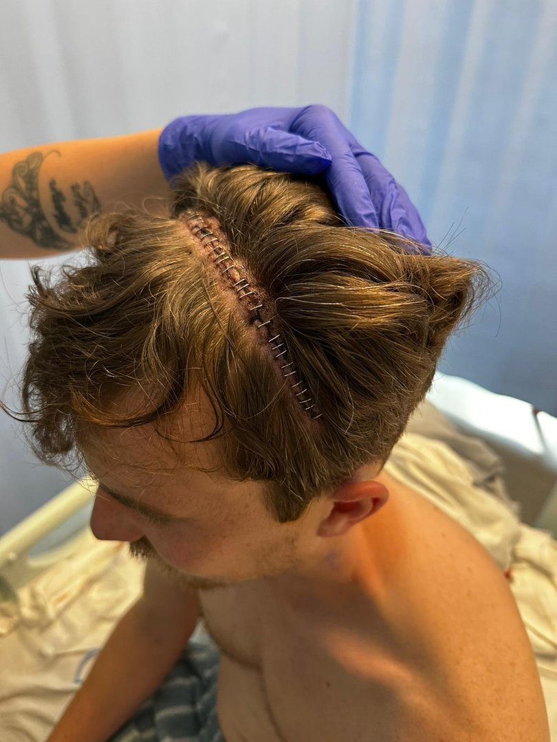 Mr Macdonald's scar and staples after undergoing open brain surgery,