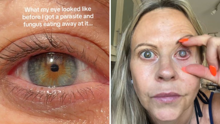 Emma Marsden contracted the parasite after falling into a wheelbarrow full of dirt and water while wearing contact lenses.