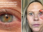 Emma Marsden contracted the parasite after falling into a wheelbarrow full of dirt and water while wearing contact lenses.