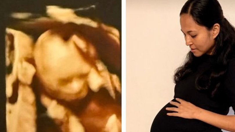 In what is believed to an Australian first, a mum has delivered four naturally conceived, identical girls after a ‘one in 15 million’ pregnancy.
