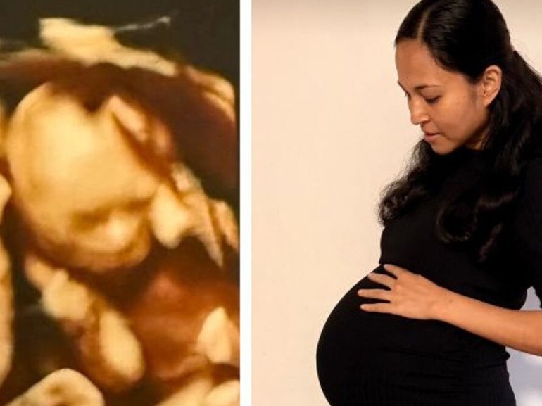 In what is believed to an Australian first, a mum has delivered four naturally conceived, identical girls after a ‘one in 15 million’ pregnancy.