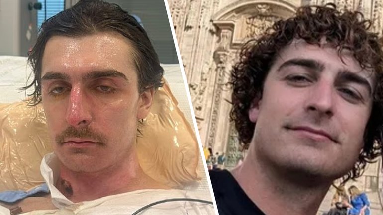 Lachie Perrem suffered burns to 75 per cent of his body when the vacuum erupted inside his Brabham home.