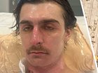 Lachie Perrem suffered burns to 75 per cent of his body when the vacuum erupted inside his Brabham home.