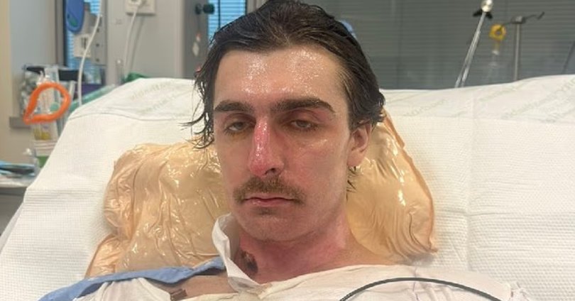 Lachie Perrem has woken from an induced coma after suffering burns to 75 per cent of his body.