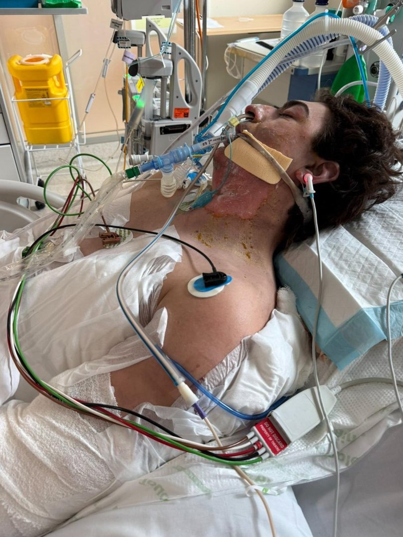 Lachie Perrem was put into an induced coma.