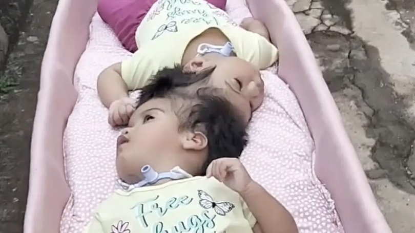 The girls were born with fused heads and shared brain tissue and blood vessels.