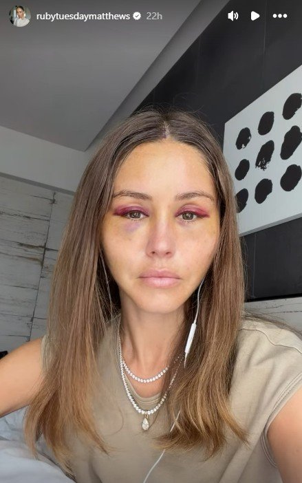 Ruby Tuesday Matthews has revealed her extreme bruising after the procedure.