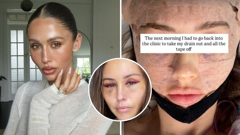 Aussie influencer Ruby Tuesday Matthews has undergone a Korean facelift in the hope of achieving a more “refreshed and awake” appearance.