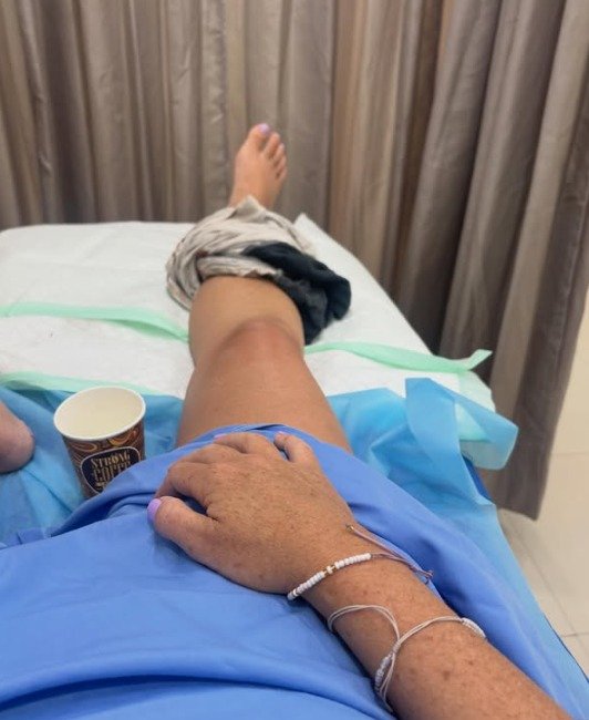 Amy Donohue was travelling as a passenger on a scooter on a remote island off Bali when the scooter lost balance, crushing her leg.
