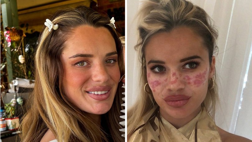 The mum-of-one revealed she was launching her own DIY freckle brand following a mishap years before that left her requiring urgent medical care.