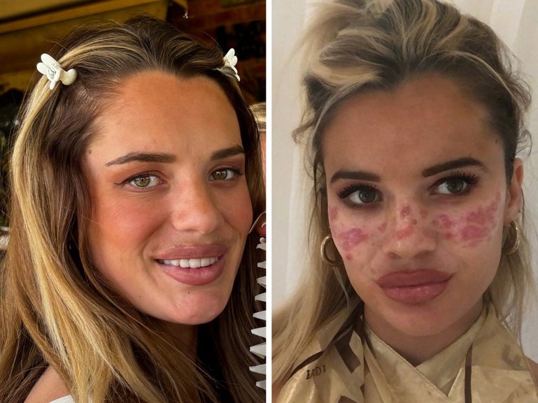The mum-of-one revealed she was launching her own DIY freckle brand following a mishap years before that left her requiring urgent medical care.