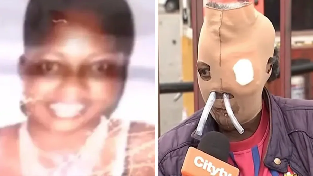 Colombian Maria Consuelo Cordoba wants to die after years of breathing through tubes after horror acid attack