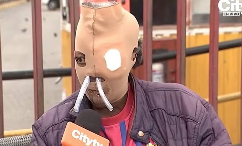Maria Consuelo Cordoba was left disfigured after her husband hurled acid at her.