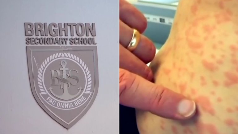 Four students have fallen ill with measles at Brighton Secondary School.
