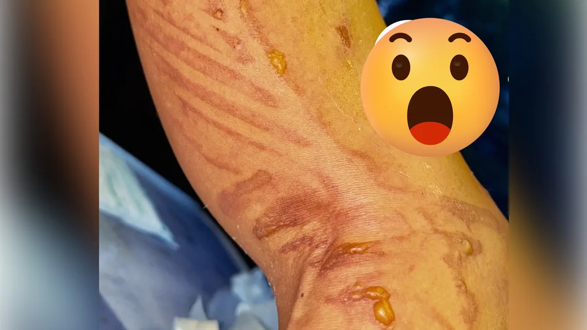 Show must go on: Nicole Scherzinger reveals horror leg injury hours before Pussycat Dolls gig in Düsseldorf Show must go on: Nicole Scherzinger reveals horror leg injury hours before Pussycat Dolls gig in Düsseldorf