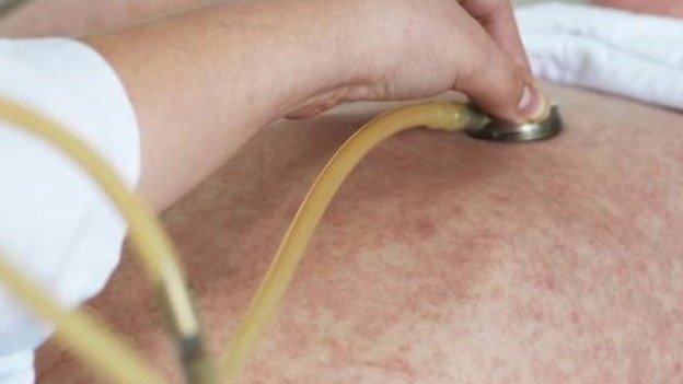 Another measles case has been linked to the Pilbara.