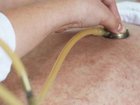 Another measles case has been linked to the Pilbara.