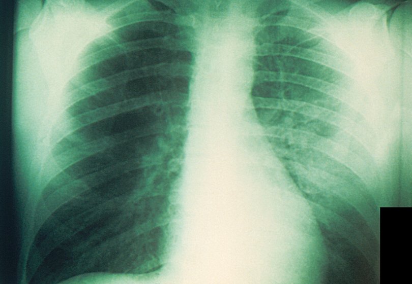 An anteroposterior chest x-ray of a plague patient revealing bilateral infection, greater on the patient's left side, which was diagnosed as a case of pneumonic plague in 1975.