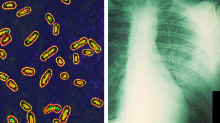 The bacteria yersinia pestis is the cause of the pneumonic plague, and, right, a chest X-ray of a plague patient on the right showing their infected lung.