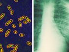 The bacteria yersinia pestis is the cause of the pneumonic plague, and, right, a chest X-ray of a plague patient on the right showing their infected lung.