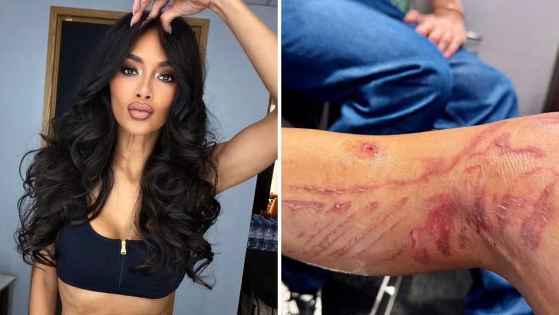 Nicole Scherzinger has shared an update on the painful burns she received after boiling water spilled on her leg before a concert last month.