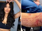 Nicole Scherzinger has shared an update on the painful burns she received after boiling water spilled on her leg before a concert last month.