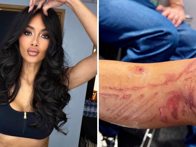 Nicole Scherzinger has shared an update on the painful burns she received after boiling water spilled on her leg before a concert last month.