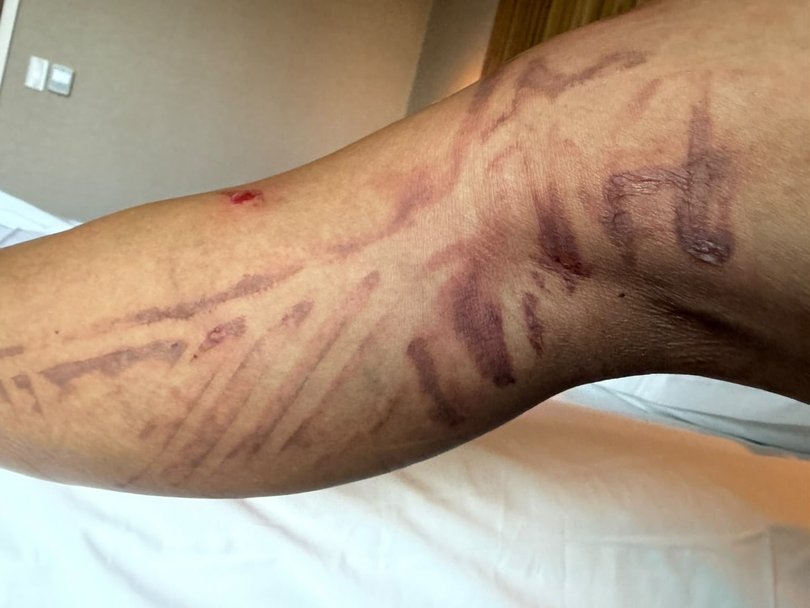 The scars on Nicole Scherzinger's leg.