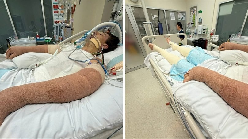 Mr Perrem has undergone at least three major surgeries including skin grafts to his fingers, left elbow and torso and wound debridement.