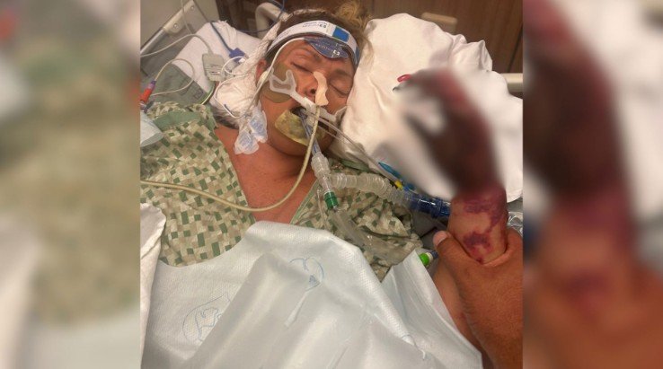 Ms Stevens went into septic shock after an infection spread throughout her body.