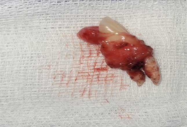 The tooth that was extracted from the boy’s eyelid.