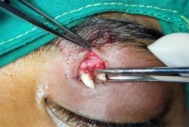 Doctors successfully performed to remove the tooth.