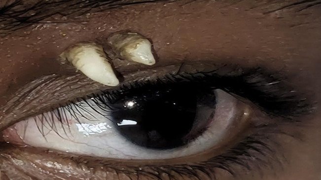 A 16-year-old boy has presented with the world’s first case of a tooth growing from an eye.