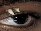 A 16-year-old boy has presented with the world’s first case of a tooth growing from an eye.